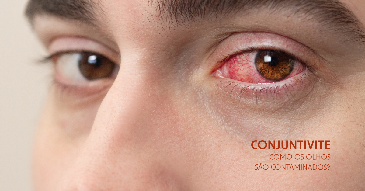 Conjuntivite: como os olhos são contaminados. 