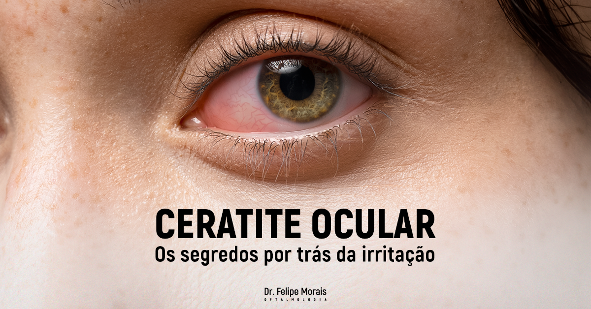 Ceratite Ocular: Conheça os Mistérios desta Doença